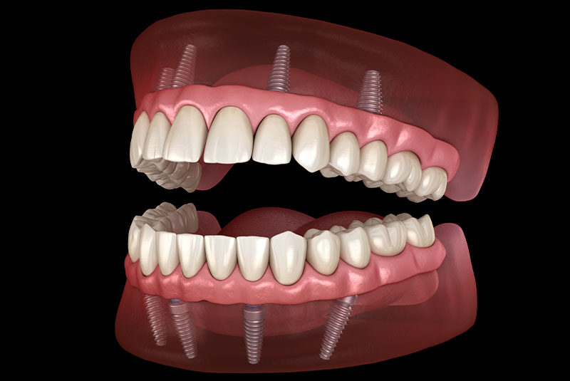 full arch dental implants