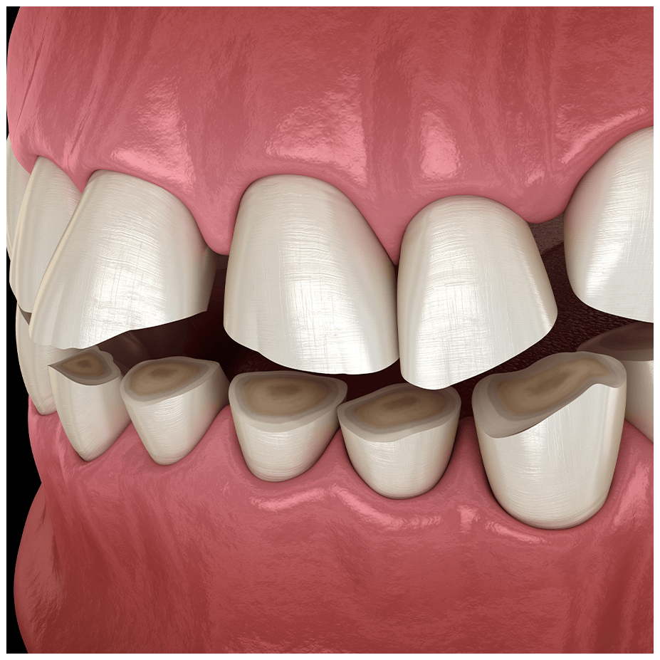 bruxism