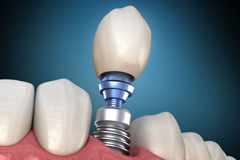 dental implant