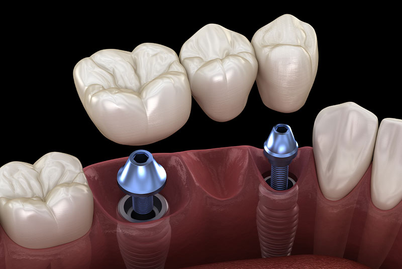dental bridge 50/50
