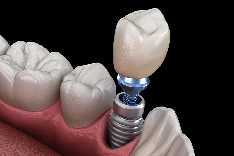 single dental implant 50/50