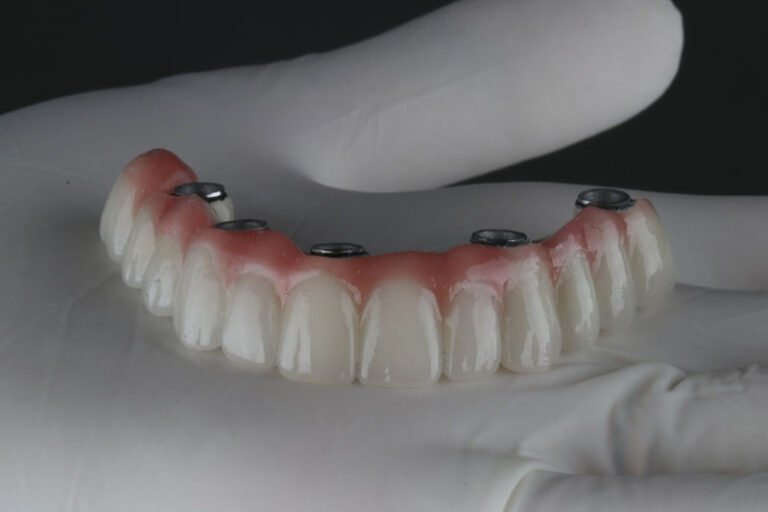 a full arch dental implants model with a set of teeth going across it