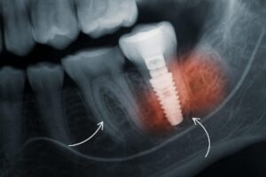 Close up of an X-ray showing a dental implant in the jawbone, highlighting the area around the implant to illustrate potential side effects, with callouts to nearby nerves. No text on image.