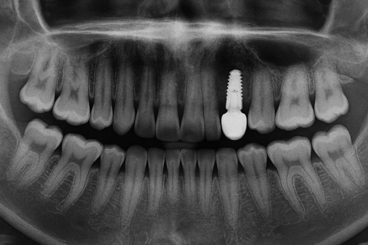 Close up X-ray of a jaw with a missing tooth, and an implant in the same spot with a replacement tooth. No text on image.