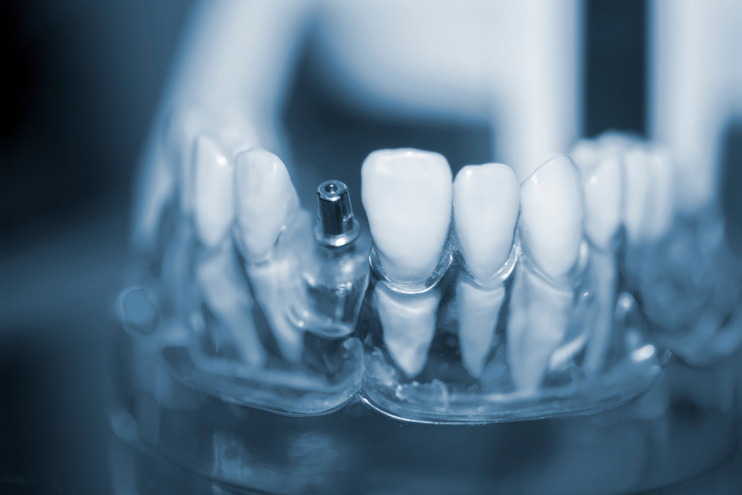 model of a dental implant on a dental table