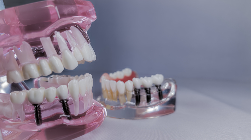 full mouth dental implant model on a dental table