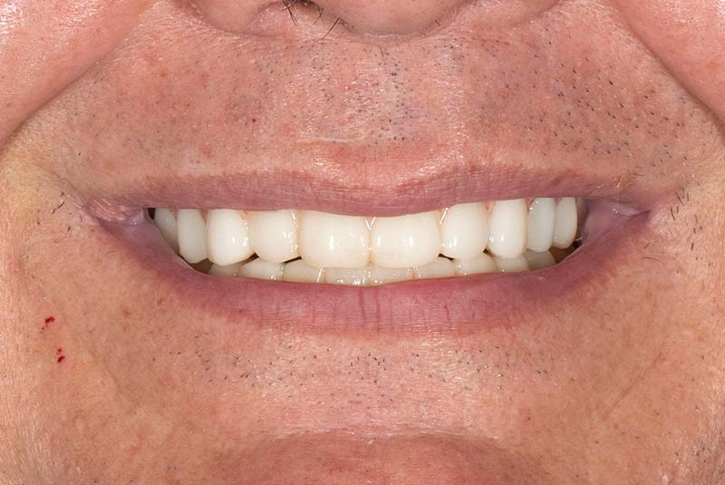 RH - U/L AOX - After