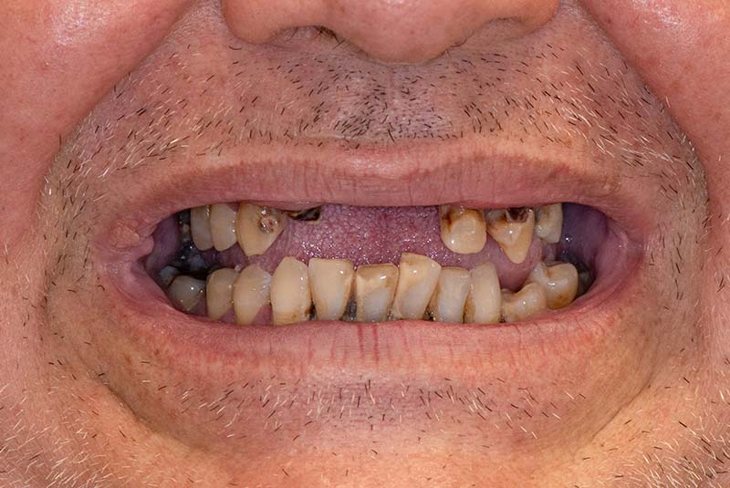 RH - U/L AOX - Before