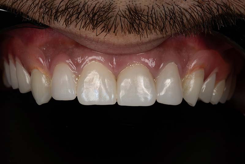 Adrian A- Veneers - After