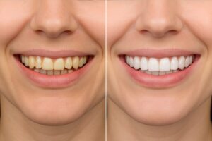A before and after photo split in half showing a patient's smile before "over teeth veneers" and then after, revealing a straighter, whiter smile. No text on image.