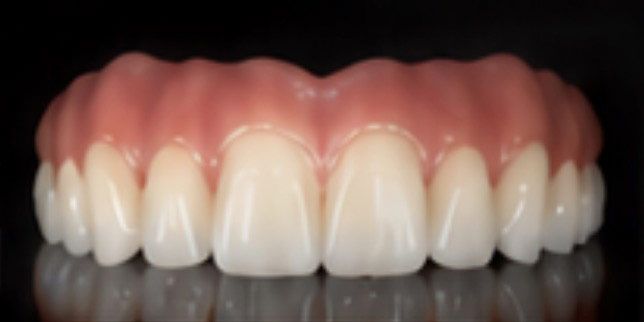 Full-Mouth Implant Restorations
